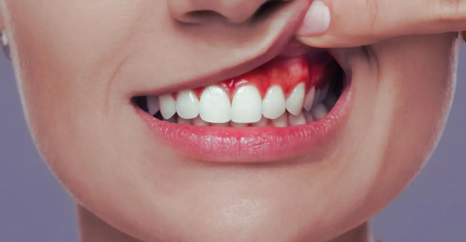 Infected Gums Treatment